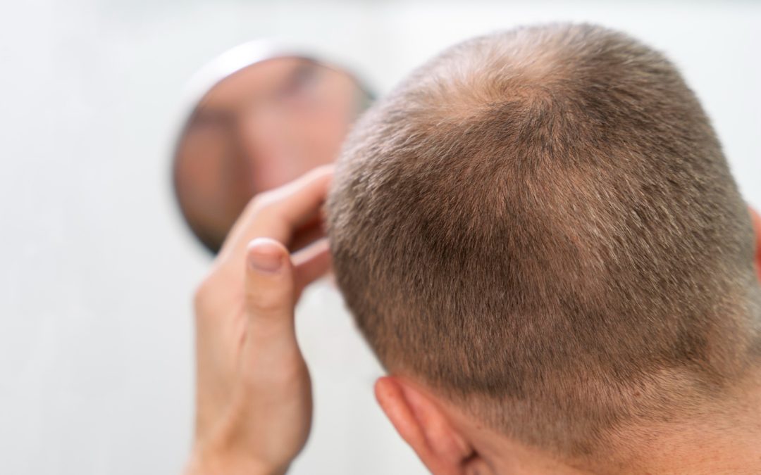 hombre con alopecia mirándose espejo